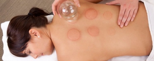 Cupping (ventosaterapia)
